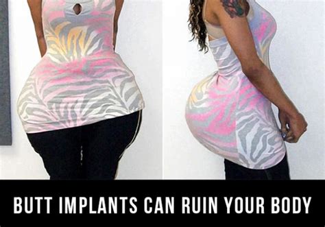 how common are fake butts